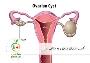 کیست تخمدان چیست و چه علائمی دارد