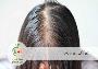 درمان نازکی موی سر زنان