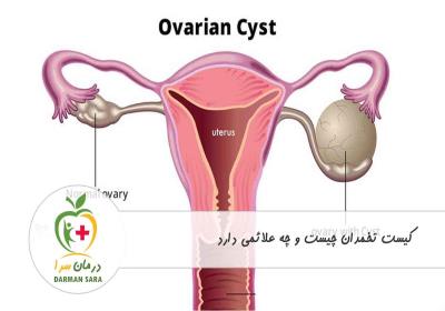 کیست تخمدان چیست و چه علائمی دارد