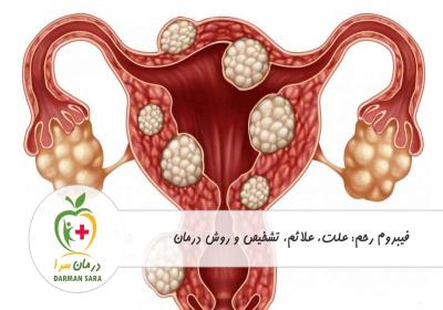 فیبروم رحم