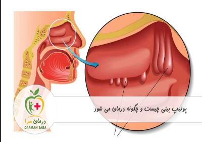 پولیپ بینی چیست و چگونه درمان می شود