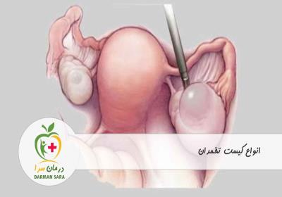 آشنایی با انواع کیست تخمدان