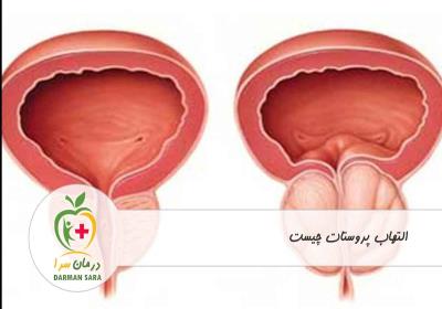 التهاب پروستات چیست